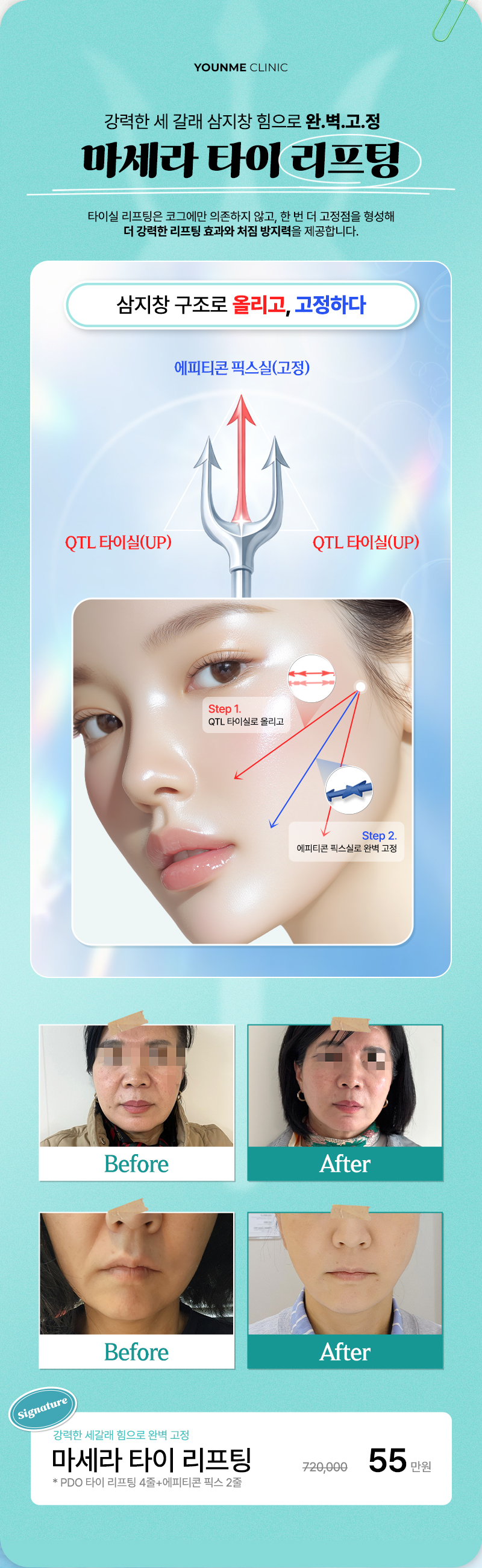 마세라 타이 리프팅