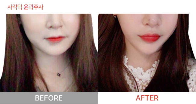 전후사진